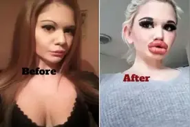 24岁网红拥有超厚嘴唇，丰唇32次大到吓人！网友：整容前那么漂亮图片