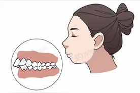 凸嘴的人看过来！如何改善凸嘴？5种矫正方法，总有一款适合你图片