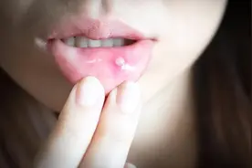 口腔溃疡就是“上火”？反复不好，或预示3种疾病，别忽视图片