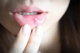 口腔溃疡就是“上火”？反复不好，或预示3种疾病，别忽视图片