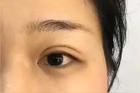 割双眼皮还可能变成“肿泡眼”？这3个坑千万要小心！图片