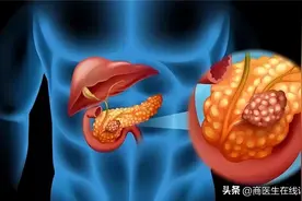 52岁男子每天大便两三次，确诊胰腺癌！3种异常或是身体警报图片