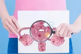 月经异常，一年后确诊宫颈癌晚期，3个症状不要忽视了图片