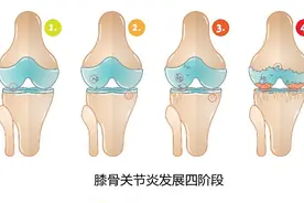 治疗骨关节炎，新药双醋瑞因和氨糖哪个好，哪个副作用大？图片