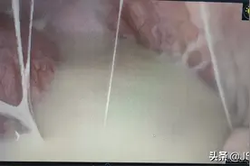 一次撞击，少女胸腔里引流出“牛奶”？图片