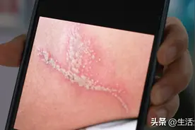 “飞行的硫酸”高发期已至 千万小心别被它毁容！图片