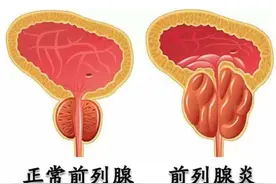 前列腺炎、前列腺增生、前列腺癌！傻傻分不清？今天一次讲清楚图片