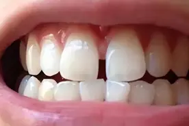 门牙缝隙大影响颜值，说话还会“漏风”，如何是好？图片