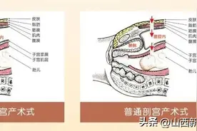 长治医学院附属和济医院丨腹膜外剖宫产助力三胎孕妈圆“好”梦图片
