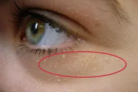 眼睑、脖子和腋下小肉粒是什么？​感染HPV病毒就会长它是真的吗？图片