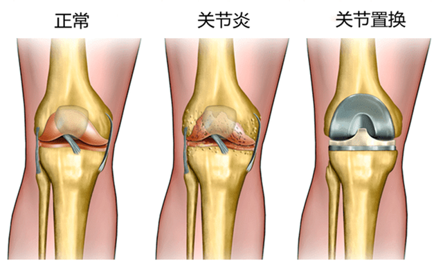 什么是膝盖关节置换术（从手术前到手术后）