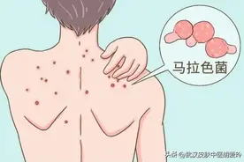 背上长了红色的痘痘很痛是怎么回事啊还痒怎么办图片