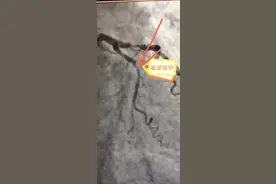 男子心脏血管重度狭窄，看似要支架！医生的决定，避免了患者支架图片