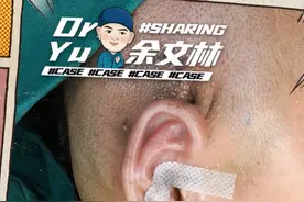 【案例分享】19岁姑娘右耳腊肠状小耳，扩张法耳再造圆她耳朵梦！图片