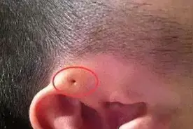 年轻妈妈看到孩子耳朵上有洞，以为是虫子用力捏了捏，结果后悔了图片