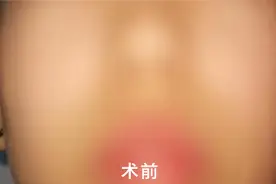 招风耳“招财更聪明”？医生：其实这是一种耳廓畸形图片