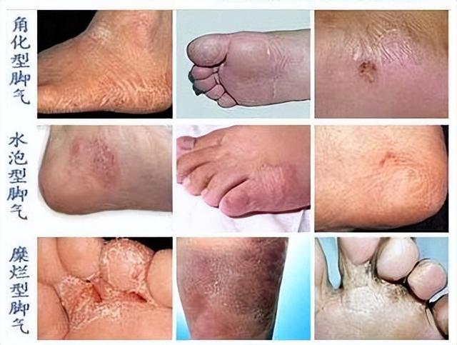 鏄ュぉ鐨偆鐥呰繘鍏ラ珮鍙戝锛佽繖浠界敤鑽ぇ鍏ㄨ鏀跺ソ