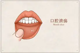 口腔溃疡吃维C好得快？搞醒豁，这个真没用图片