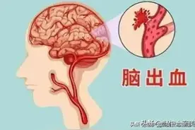 脑出血前的这13大表现，一旦出现要提高警惕图片