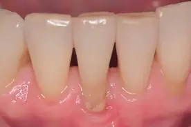 牙龈萎缩不可逆，掌握方法可预防图片