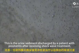 前列腺炎病友冲击波治疗后，排出陈旧J液图片
