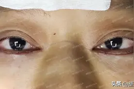 外切祛眼袋刚30天，朋友同事见面没敢认，都说我像变了一个人图片