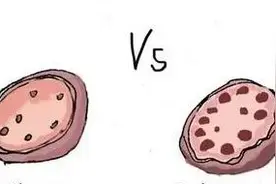 多囊，究竟是什么？图片