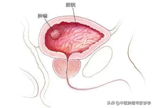 中医是如何通过“望、闻、问、切”了解肿瘤患者病情的