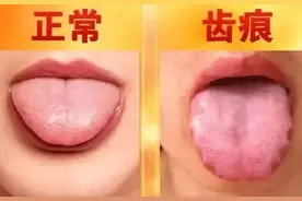 7种舌头暗示健康问题！协和中医科专家喊你，吐舌头看看图片