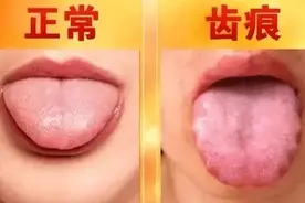 7种舌头暗示健康问题！协和中医科专家喊你，吐舌头看看图片