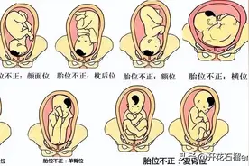 低头出生和仰头出生有区别吗？屁股比头要小，先出不是更容易？图片