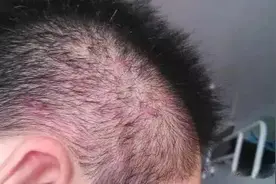 头皮上起了又红又硬的痘痘，还能挤出黄色分泌物，是怎么回事图片