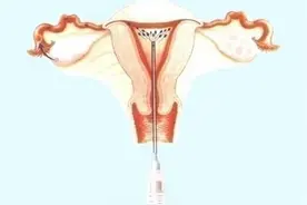 人工授精需要具备什么条件？适合哪些人群？又有哪些常见误区呢？图片