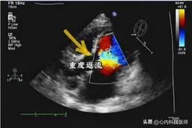 二尖瓣、三尖瓣轻度返流，是啥意思？要治疗吗？听医生怎么说图片