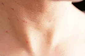 皮肤上的小肉球、小肉疙瘩是咋回事？这4种可能与hpv感染有关图片