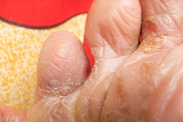 脚趾缝痒脱皮抓破后出水鳞屑角化型