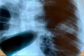 肺里有积水就是肺癌的表现？柯主任：谁告诉你的图片