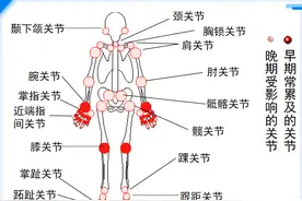 如何诊断类风湿关节炎？图片