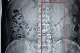 泌尿结石微创术后必读：关于双J管你应该知道的事图片