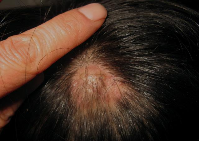 头上总是长出疙瘩和脓包,到底是咋回事?医生:可能和这7点有关