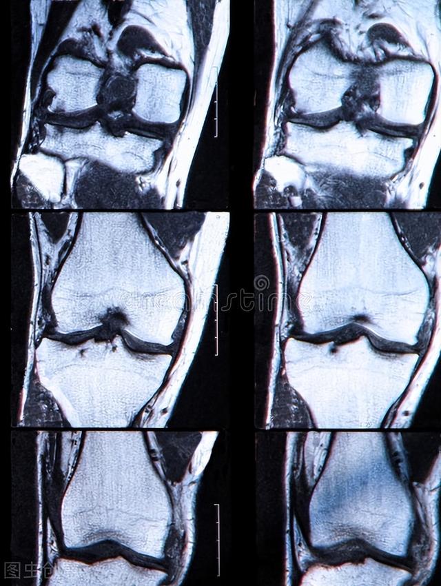 膝盖前十字交叉韧带断裂,需要手术吗?