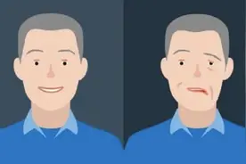 贝尔面瘫，生活中最常见的面瘫类型图片