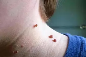 脖子和腋下长的“小肉粒”是什么？会影响健康吗？早知早受益图片