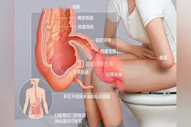 “不死的癌症”——克罗恩病图片