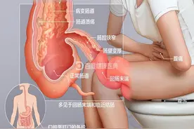 “不死的癌症”——克罗恩病图片
