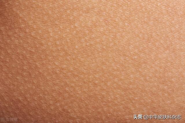 去鸡皮蛇皮鱼鳞皮肤的