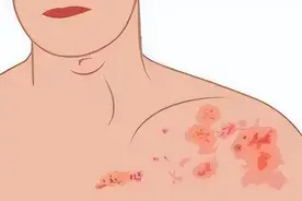 小心“急痛”变“慢痛”！带状疱疹不要拖图片