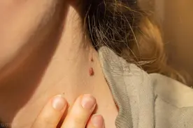 警惕！脖子腋下长出小肉粒，HPV感染还是肉赘？抠掉会有哪些风险图片