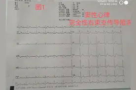 完全性右束支传导阻滞图片
