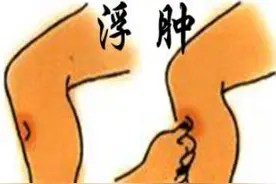 消水肿按摩5穴道，营养师快速消水肿食物名单大公开图片